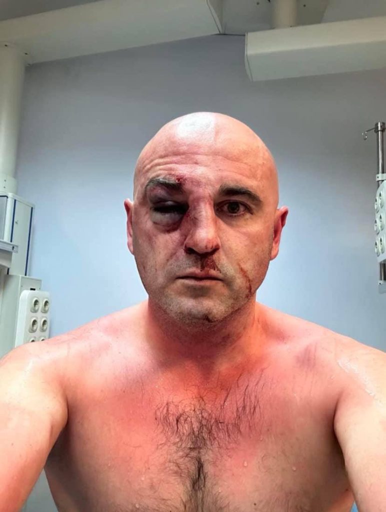 Levan Khabeishvili, the chairman of the main opposition party "United National Movement," was brutally beaten during the protests, and he has been diagnosed with a broken nose.